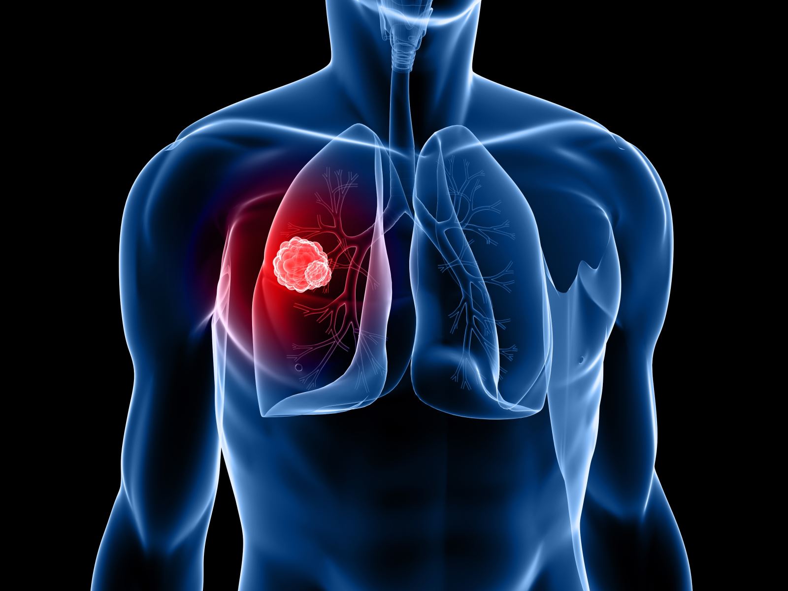 radiographic presentation of lung cancer